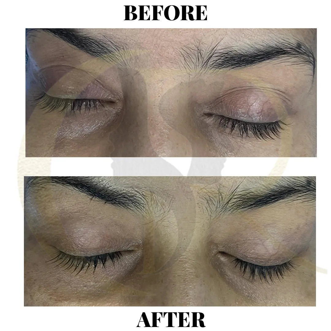 Anti-aging treatment result showing Robotic Face Lift (Ultraformer MPT) on Day 10 along with Beauty Drip IV Infusion Therapy at Cosmo Radiance Hyderabad India